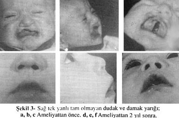 BULGULAR Millard yöntemi ile birlikte yukarda anlatılan işlemle tek yanlı tam olmayan dudak (2), tam dudak (4) ve tam dudak damak yarıklı (4) olmak üzere toplam 10 hasta ameliyat edildi.