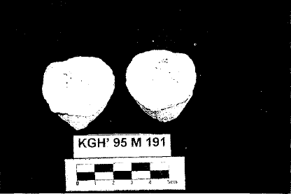 Resim 2: KGH'95 M169 numaralı materyale ait tüberküloz izleri (Özer ve diğerleri, 1999) Resim 3: KGH'95 M19l numaralı materyale ait tüberküloz izleri (Özer ve diğerleri, 1999) Karagündüz Erken Demir