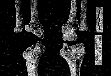 Hakkari Erken Demir Çağı insan iskeletlerinden, bir erkeğe ait sağ claviculada gövde ve epifizler enfeksiyondan etkilenmiştir.