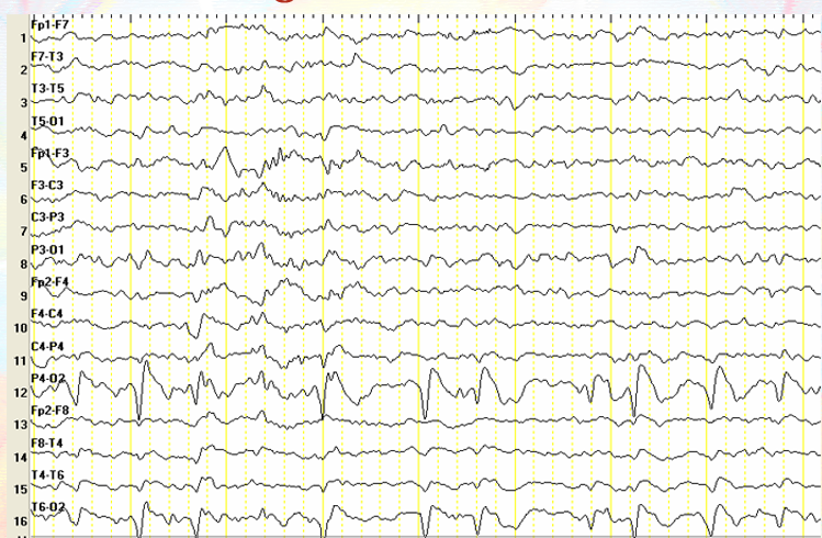 Fokal Epileptiform Aktivite: İnteriktal