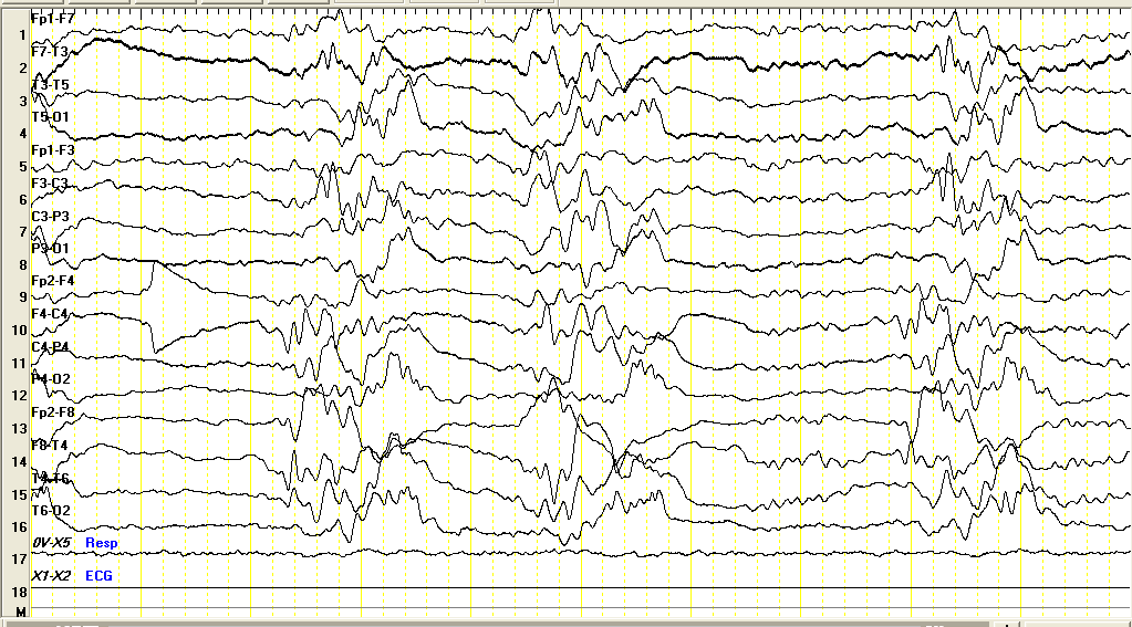 SUPRESYON BURST PATERNĠ ED 2.