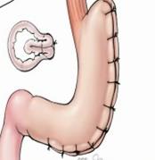 Gastrik Plikasyon, Sleeve Gastrektomiye Rakip Olur mu? Sonuç olarak.