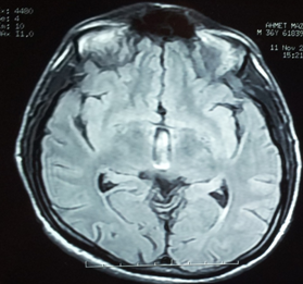 Resim 2: Olgunun Kraniyel MR görüntülemesi Hasta halen kliniğimizde Nöroakantositoz tanısıyla izlenmektedir. Hastanın ağız yaralarını engellemek için ağız apareyi önerildi. Hastaya lorezepam 2.