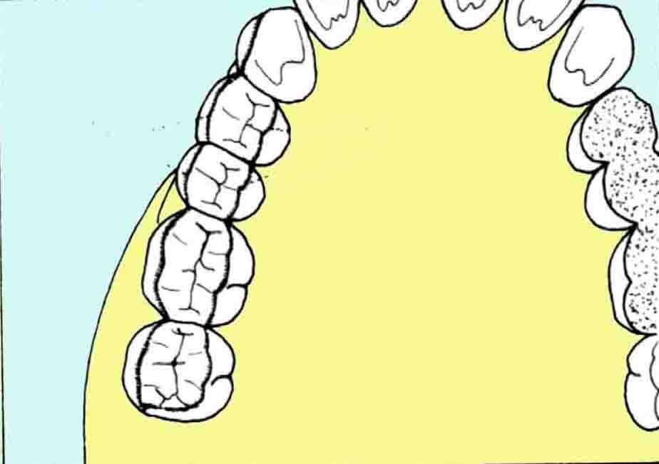 1. Üst diş arkında oklüzal yüz elemanlarının belirlenmesi Bukkooklüzal kenar çizgisi Palatino oklüzal kenar çizgisi