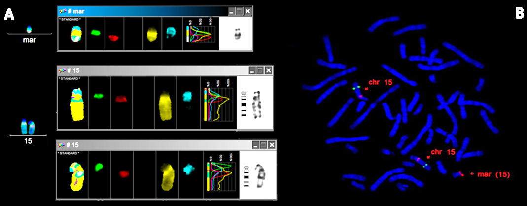 58 Şekil 4.21: A) Olgu 7 nin 15. kromozom için subcenm-fish analizi sonucu (Yeşil: Sentromerik prob, kırmızı: 15q11.