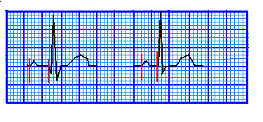 PR intervali P süresi (atrial depolarizasyon için geçen süre) +PQ segment (AV nodda impulsın fizyolojik gecikmesi) = PR interval PR intervali yaş ve kalp