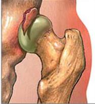 Ligament ve kapsül yaralanması gibi ciddi sorunlar ortaya çıkabilir. Eklem yüzeyleri birbirinden tamamen ayrılmış kemik uçları değişik pozisyonlarda kilitlenmiş olabilir.