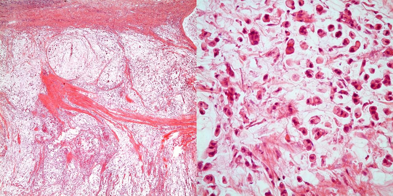 38 A B C Şekil 4.6 A,B) Memenin lobüler karsinomunun mide metastazında, ER pozitif neoplastik hücrelerin lamina propriaya tek tek dağıldığı immünohistokimyasal çalışma ile seçilebilmektedir (x20).