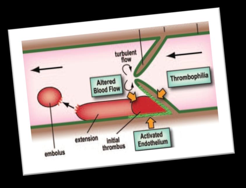 Trombofilia, endotel aktivasyonu, kan akım anomalileri.
