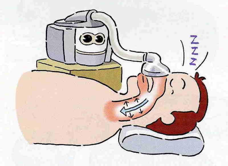 CPAP Tedavisi ; OSAS ta görülen ; Horlama
