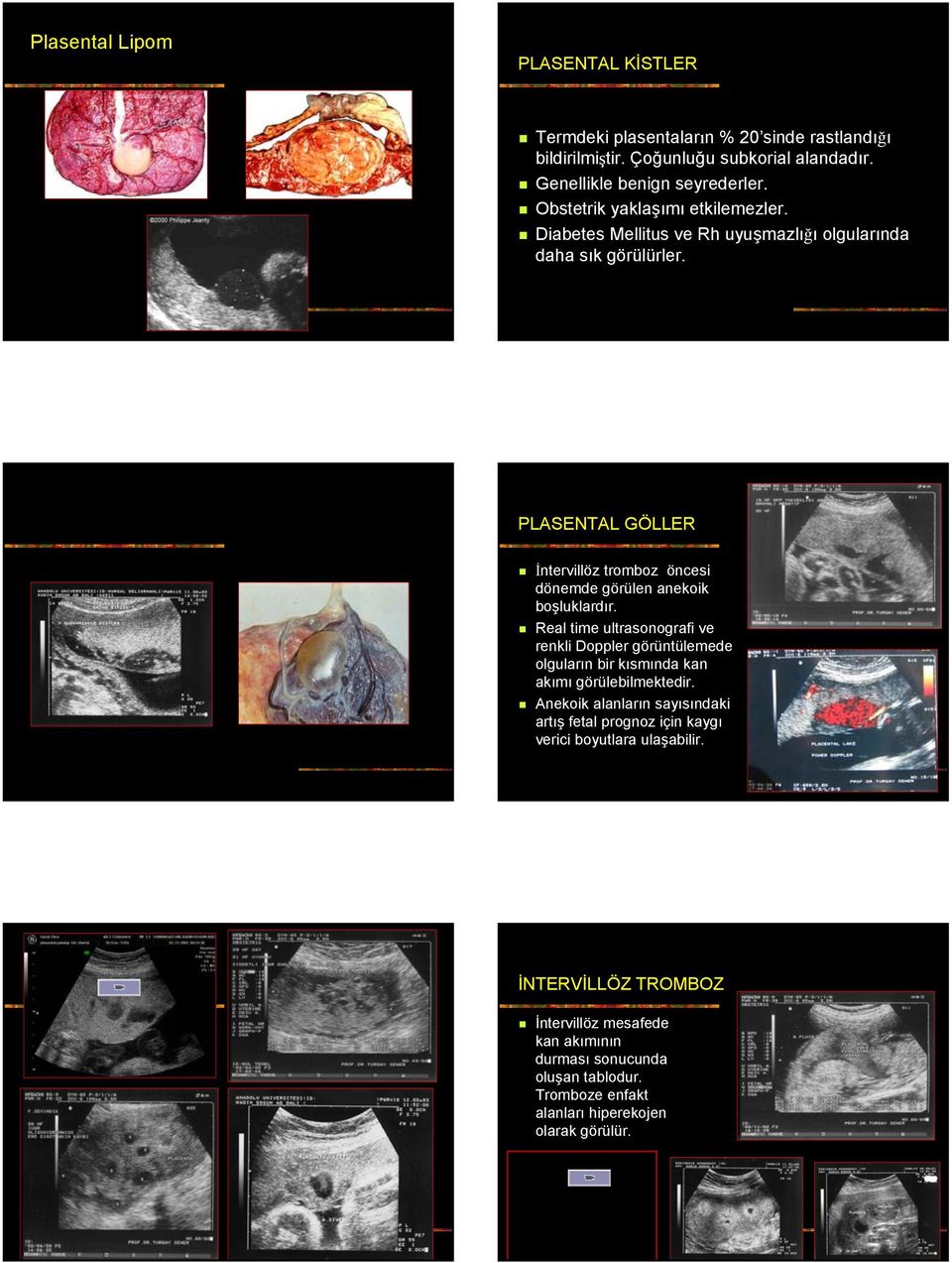 PLASENTAL GÖLLER İntervillöz tromboz öncesi dönemde görülen anekoik boşluklardır.