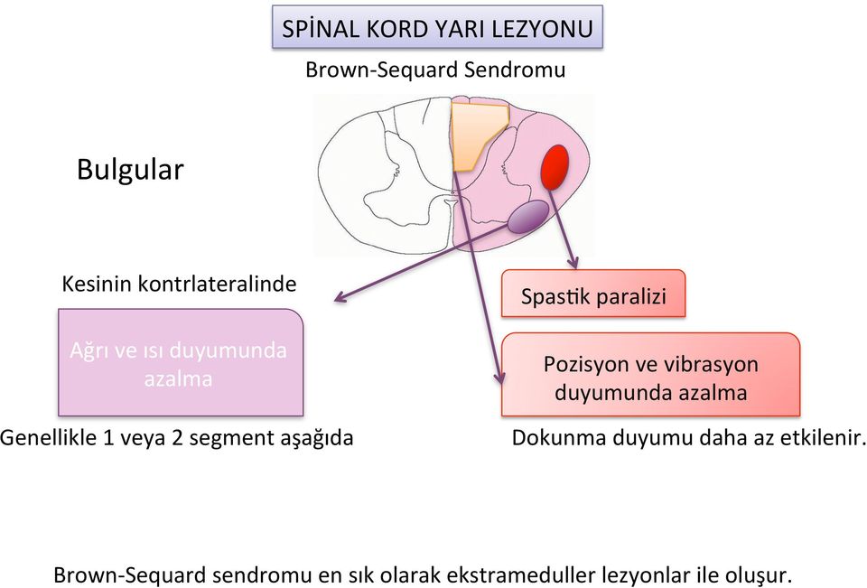 aşağıda SpasDk paralizi Pozisyon ve vibrasyon duyumunda azalma Dokunma duyumu