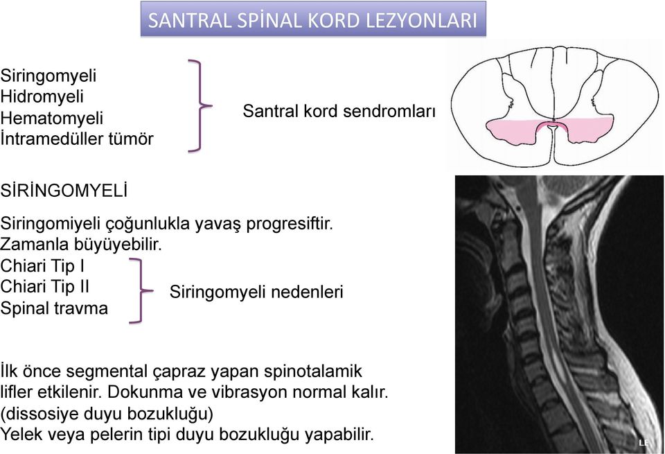 Chiari Tip I Chiari Tip II Siringomyeli nedenleri Spinal travma İlk önce segmental çapraz yapan