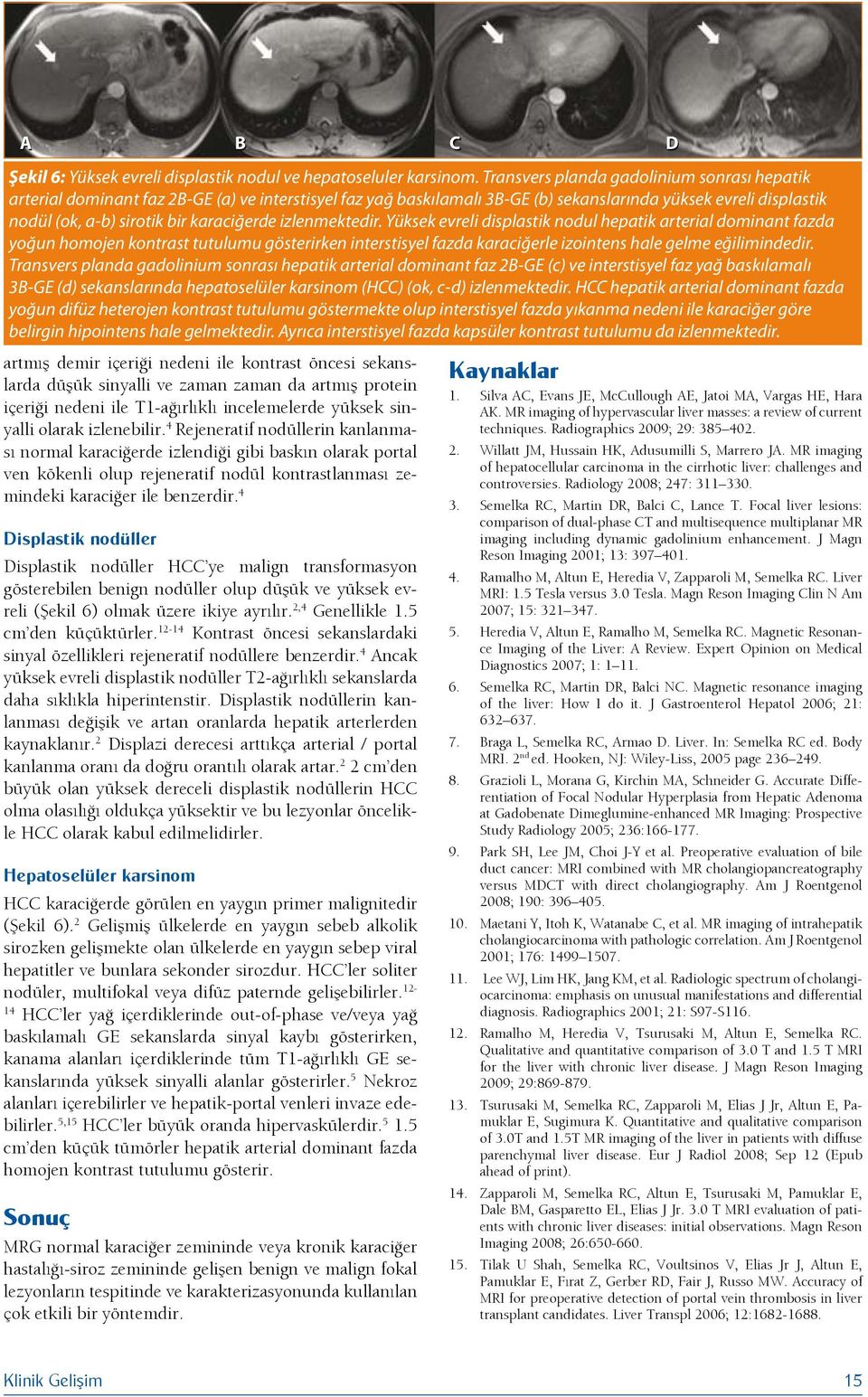 4 isplastik nodüller isplastik nodüller H ye malign transformasyon gösterebilen benign nodüller olup düşük ve yüksek evreli (Şekil 6) olmak üzere ikiye ayrılır. 2,4 Genellikle 1.5 cm den küçüktürler.