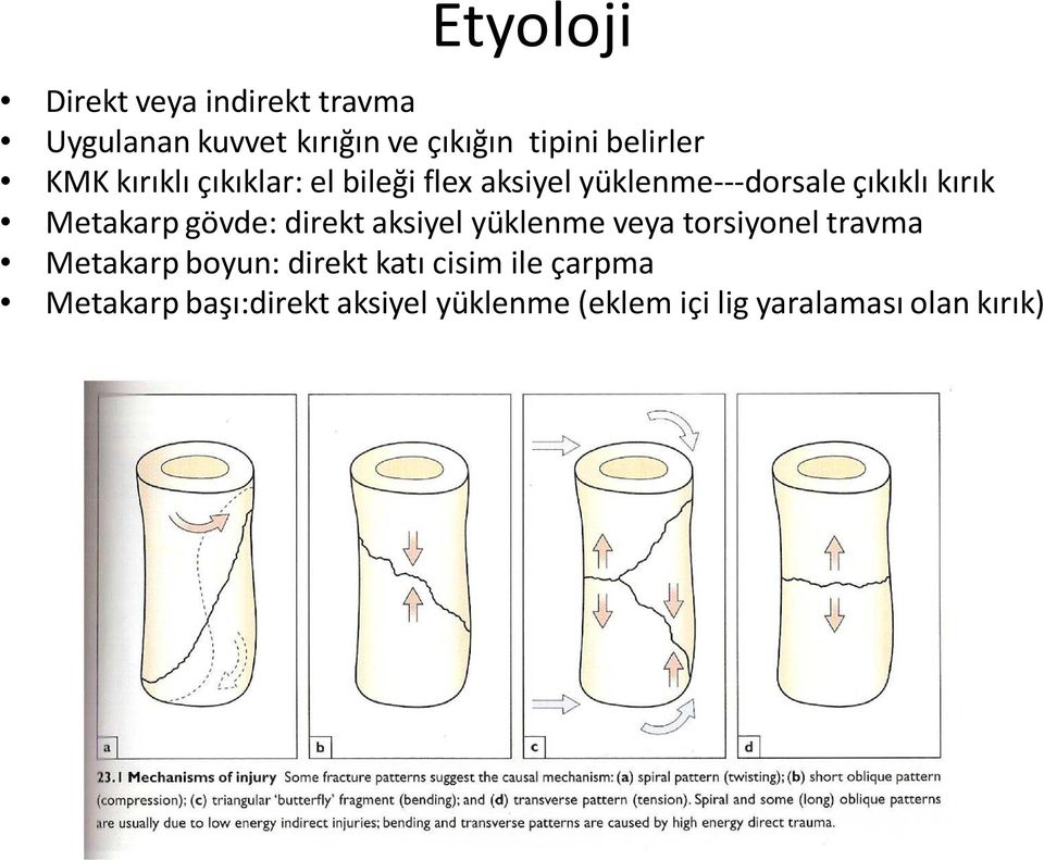 Metakarp gövde: direkt aksiyel yüklenme veya torsiyonel travma Metakarp boyun: direkt