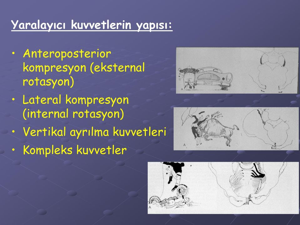 rotasyon) Lateral kompresyon (internal