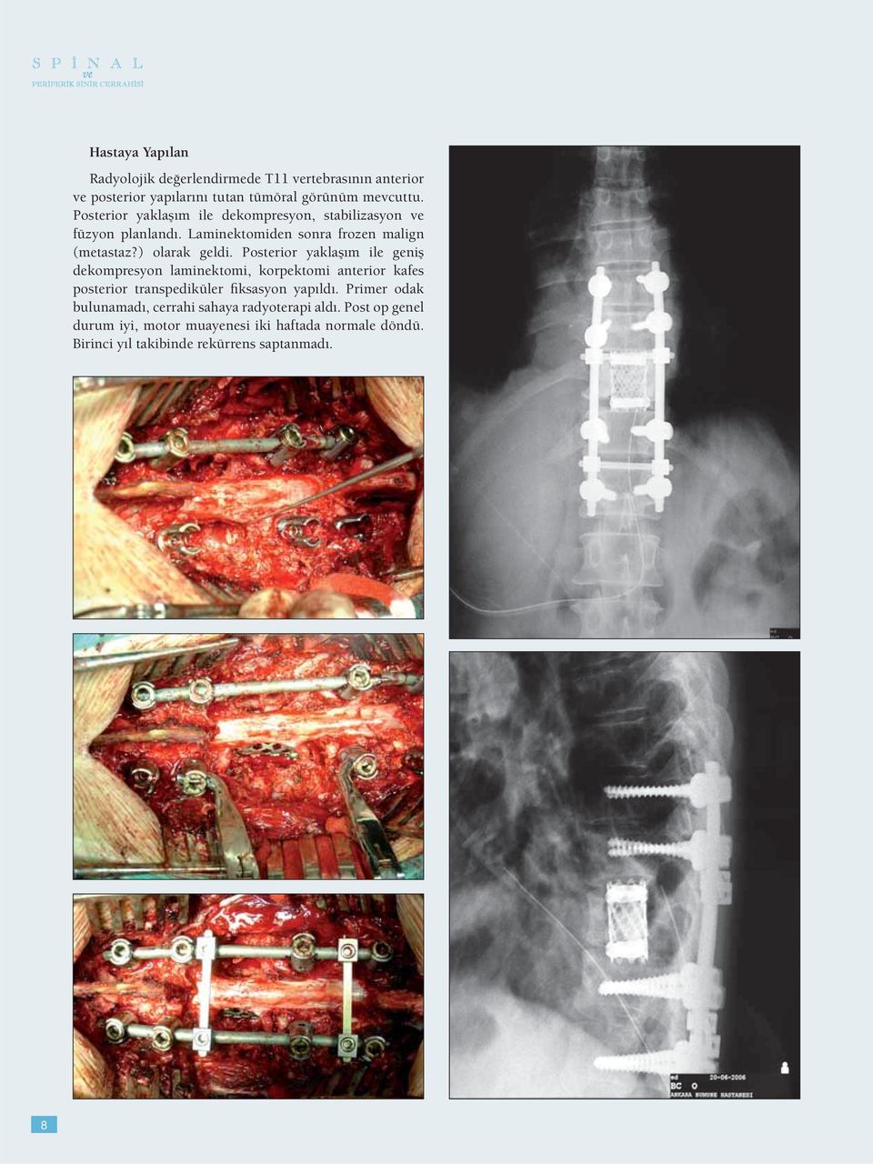 Posterior yaklaşım ile geniş dekompresyon laminektomi, korpektomi anterior kafes posterior transpediküler fiksasyon yapıldı.