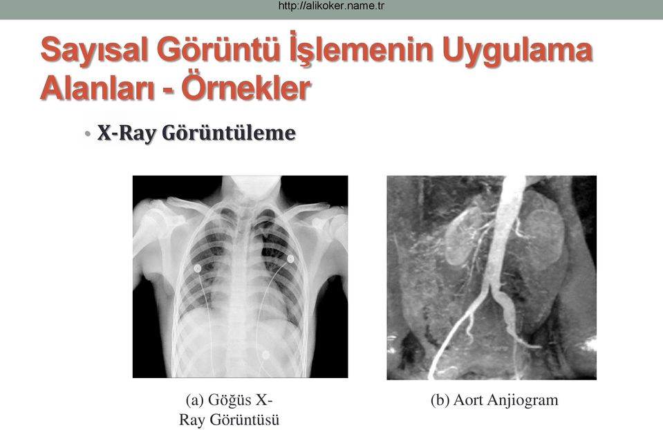 X-Ray Görüntüleme (a) Göğüs
