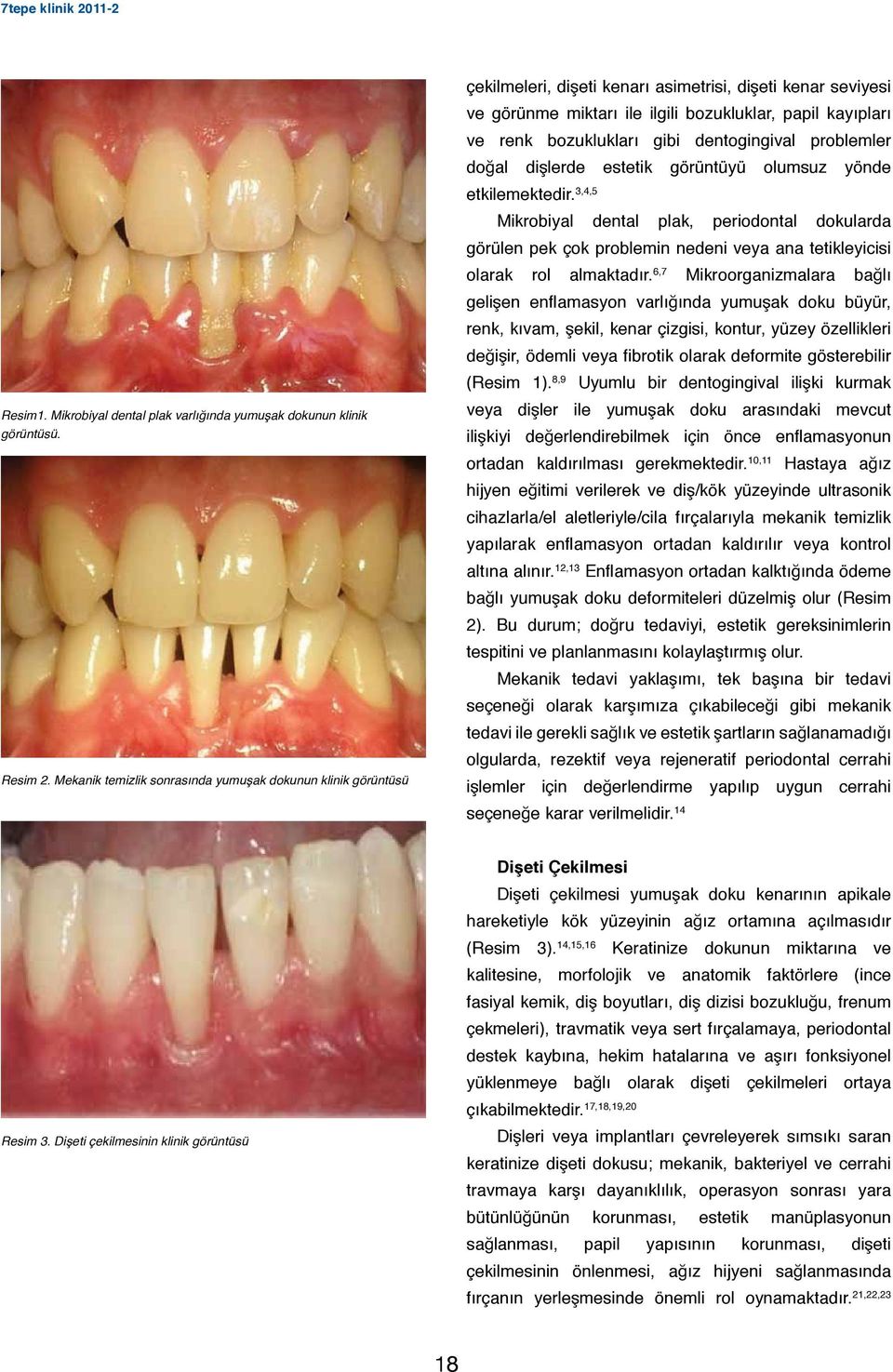 bozuklukları gibi dentogingival problemler doğal dişlerde estetik görüntüyü olumsuz yönde etkilemektedir.