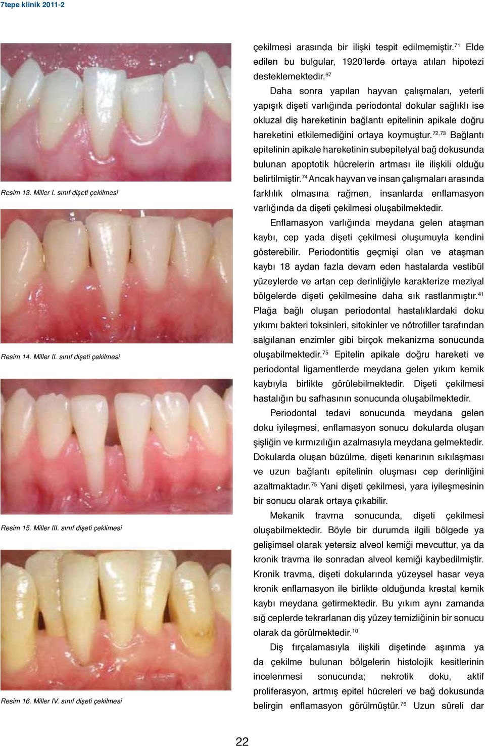 67 Daha sonra yapılan hayvan çalışmaları, yeterli yapışık dişeti varlığında periodontal dokular sağlıklı ise okluzal diş hareketinin bağlantı epitelinin apikale doğru hareketini etkilemediğini ortaya