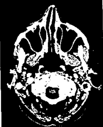 72 4.1.11. Bilgisayarlı Tomografi Bilgisayarlı tomografinin temel problemi, kesit boyunca geçen x-ışınlarından toplanan verileri kullanarak insan vücudunun bir kesitinin görüntüsünü resmetmektir.