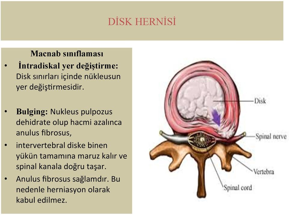 Bulging: Nukleus pulpozus dehidrate olup hacmi azalınca anulus fibrosus,