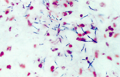 Nocardia N.astreoides kompleks N.abscessus N.