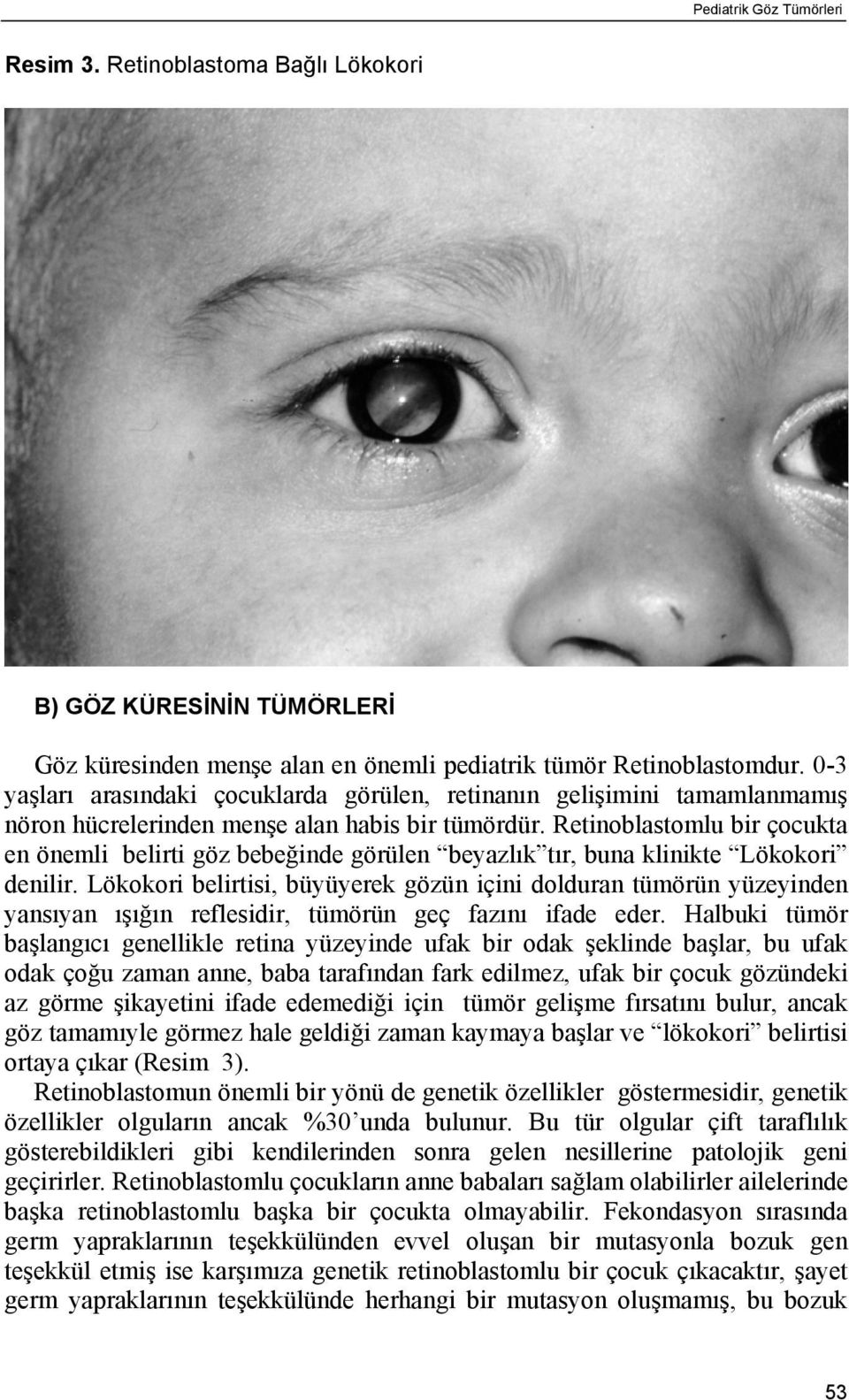 Retinoblastomlu bir çocukta en önemli belirti göz bebeğinde görülen beyazlık tır, buna klinikte Lökokori denilir.