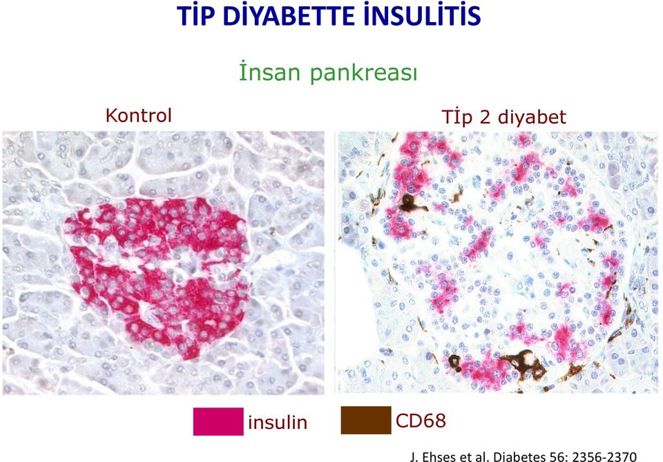 2 diyabet insulin CD68 J.