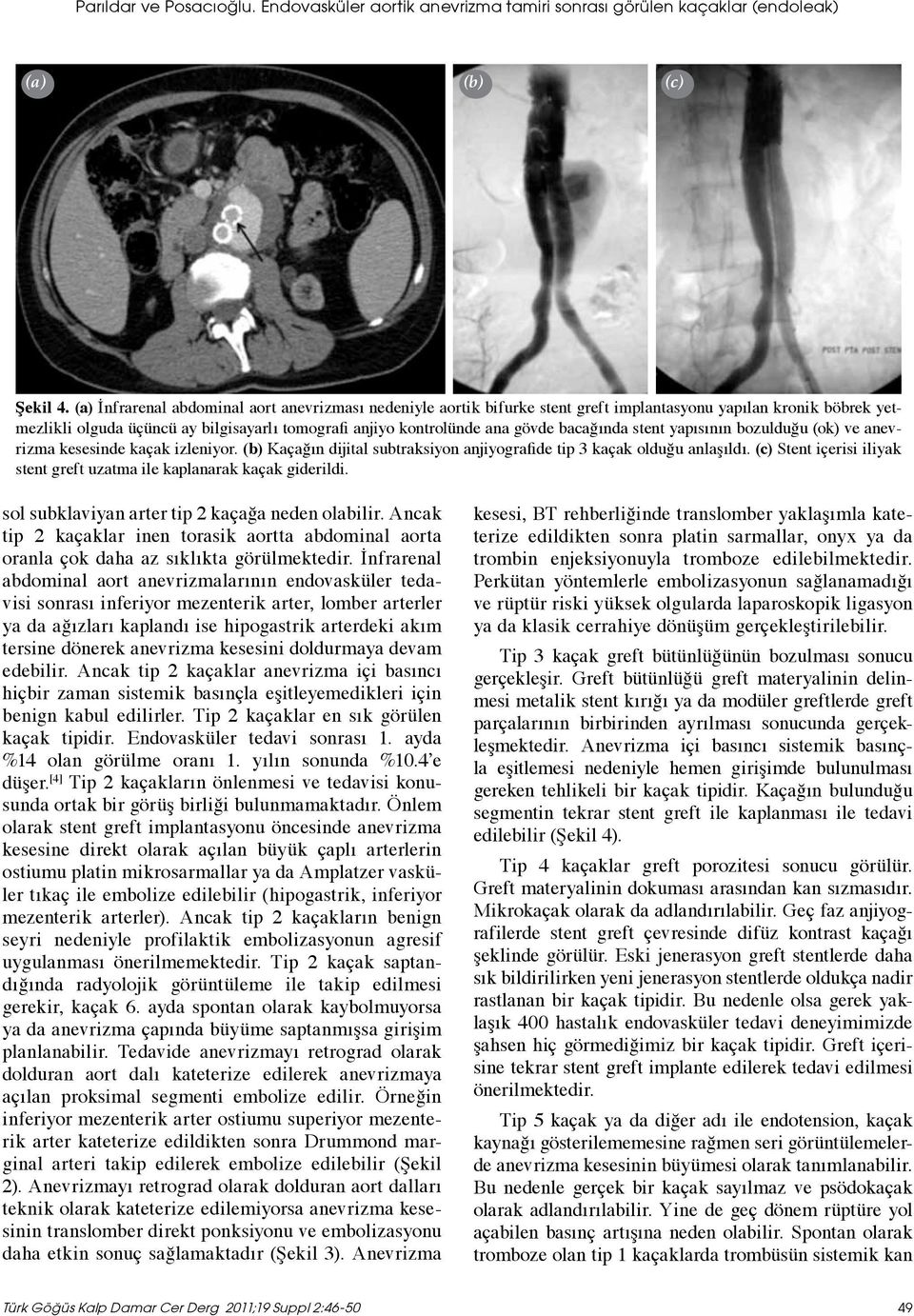 bacağında stent yapısının bozulduğu (ok) ve anevrizma kesesinde kaçak izleniyor. (b) Kaçağın dijital subtraksiyon anjiyografide tip 3 kaçak olduğu anlaşıldı.