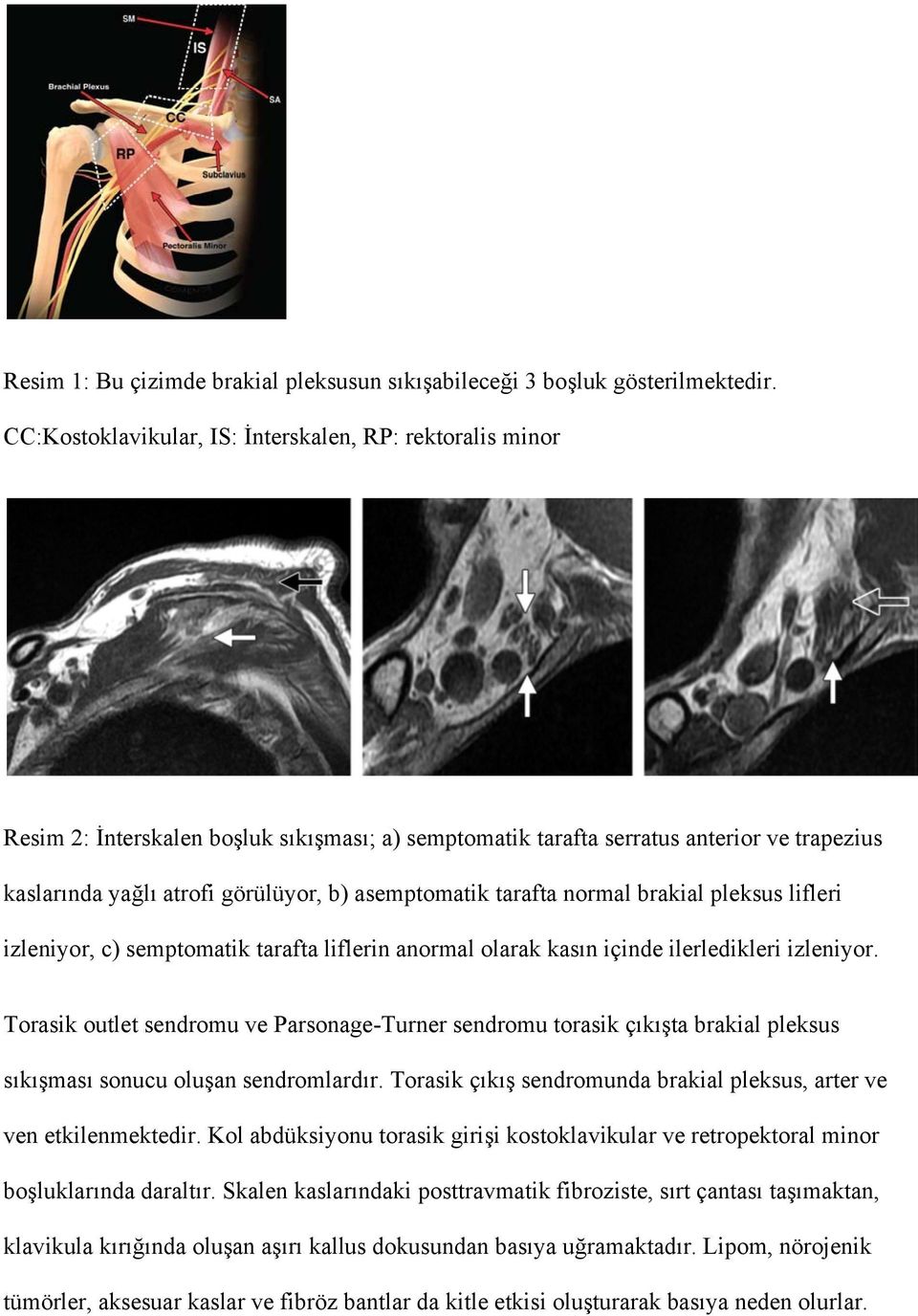 asemptomatik tarafta normal brakial pleksus lifleri izleniyor, c) semptomatik tarafta liflerin anormal olarak kasın içinde ilerledikleri izleniyor.