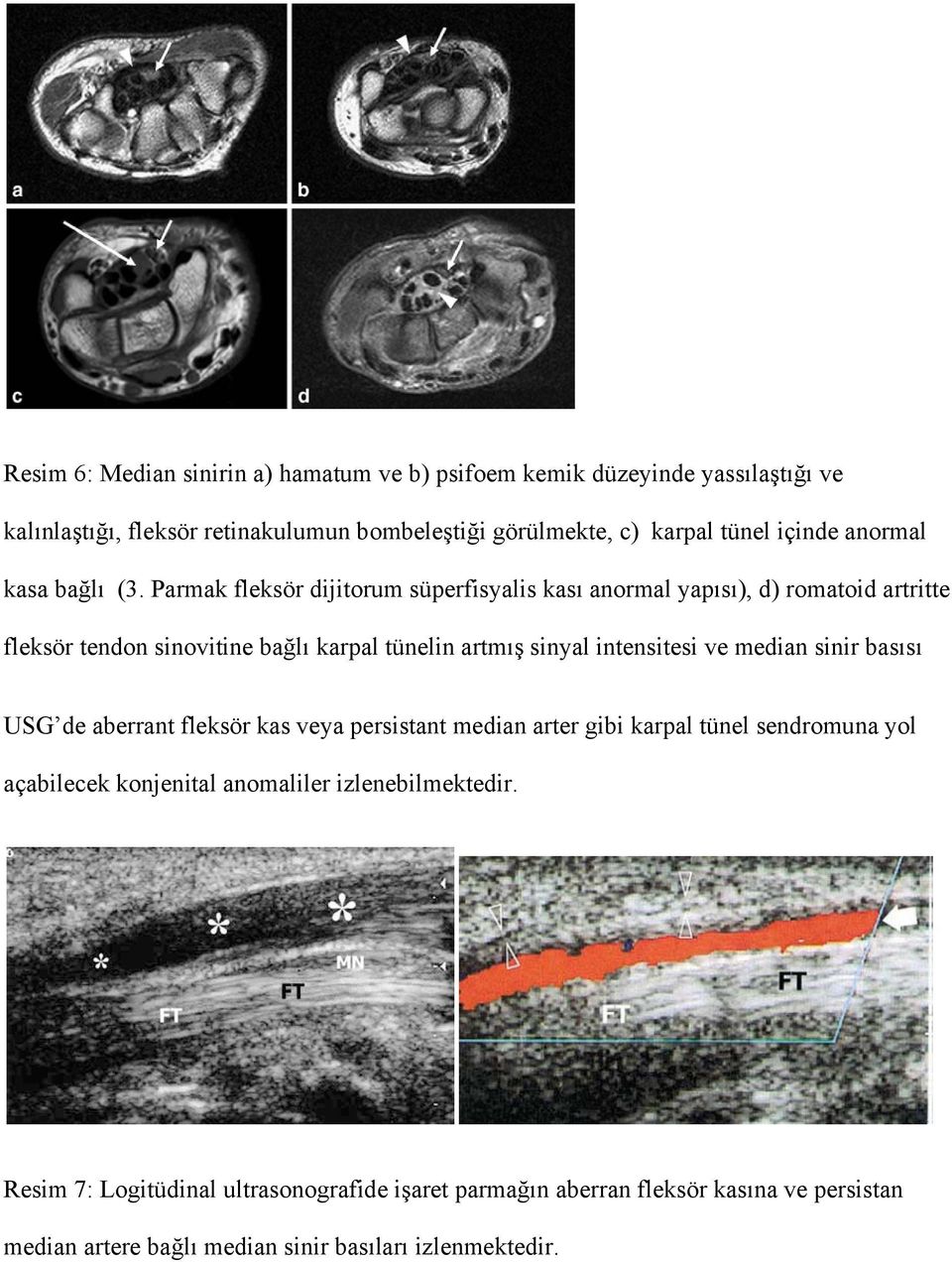 Parmak fleksör dijitorum süperfisyalis kası anormal yapısı), d) romatoid artritte fleksör tendon sinovitine bağlı karpal tünelin artmış sinyal intensitesi ve