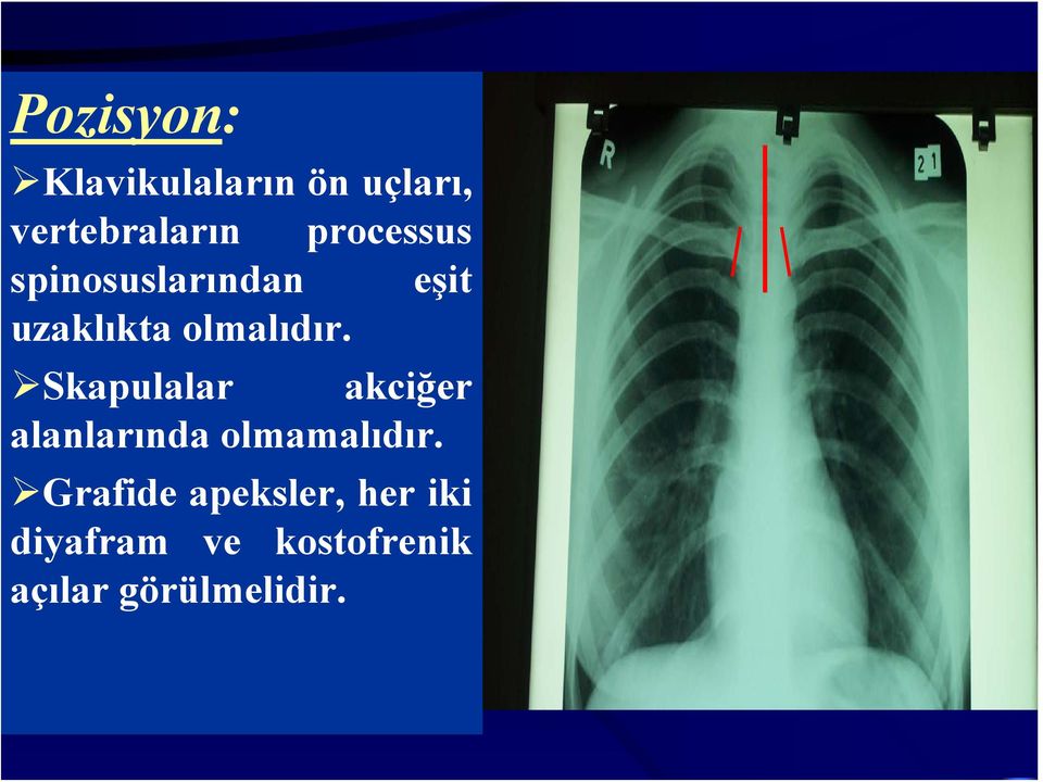 Skapulalar akciğer alanlarında olmamalıdır.