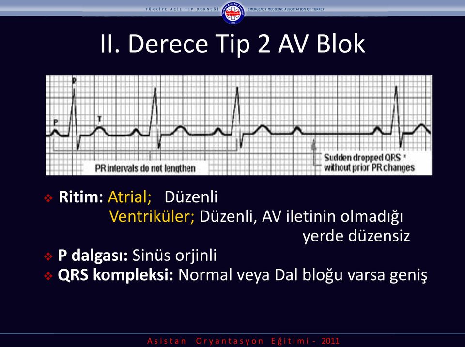 olmadığı yerde düzensiz P dalgası: Sinüs