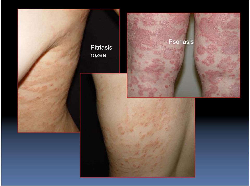 Psoriasis