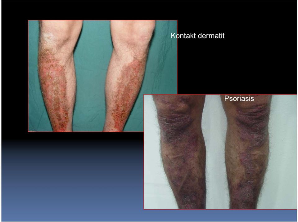 Psoriasis