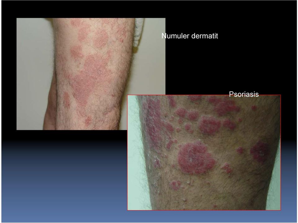 Psoriasis