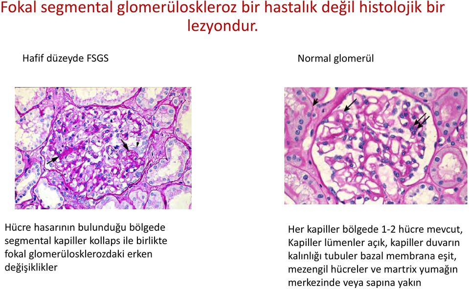 birlikte fokal glomerülosklerozdaki erken değişiklikler Her kapiller bölgede 1-2 hücre mevcut, Kapiller