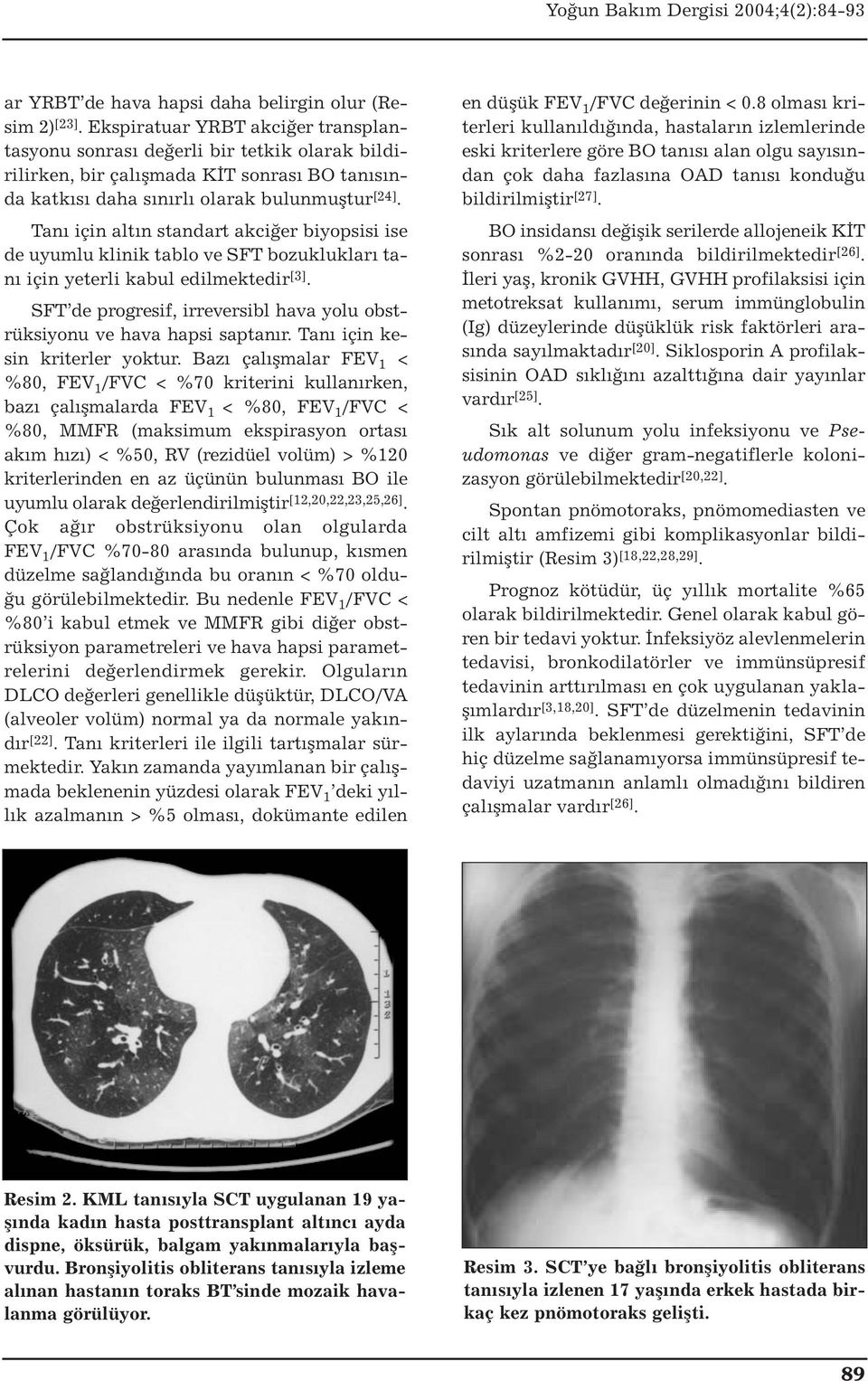 Tanı için altın standart akciğer biyopsisi ise de uyumlu klinik tablo ve SFT bozuklukları tanı için yeterli kabul edilmektedir [3].