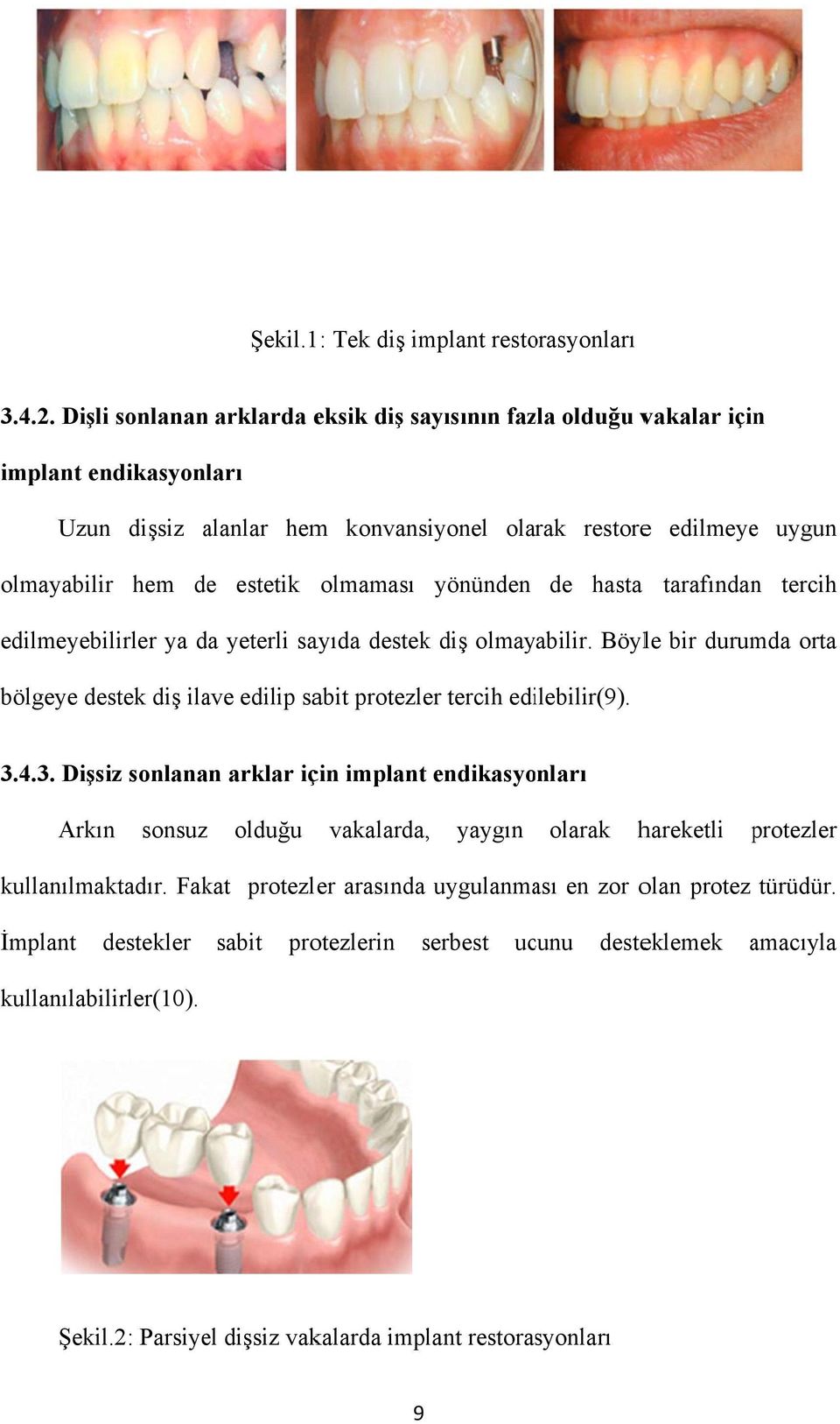 yönünden de hasta tarafındann tercih edilmeyebilirler ya da yeterli sayıda destek diş olmayabilir. Böyle bir durumda orta bölgeye destek diş ilave edilip sabit protezler tercih edilebilir(9). 3.