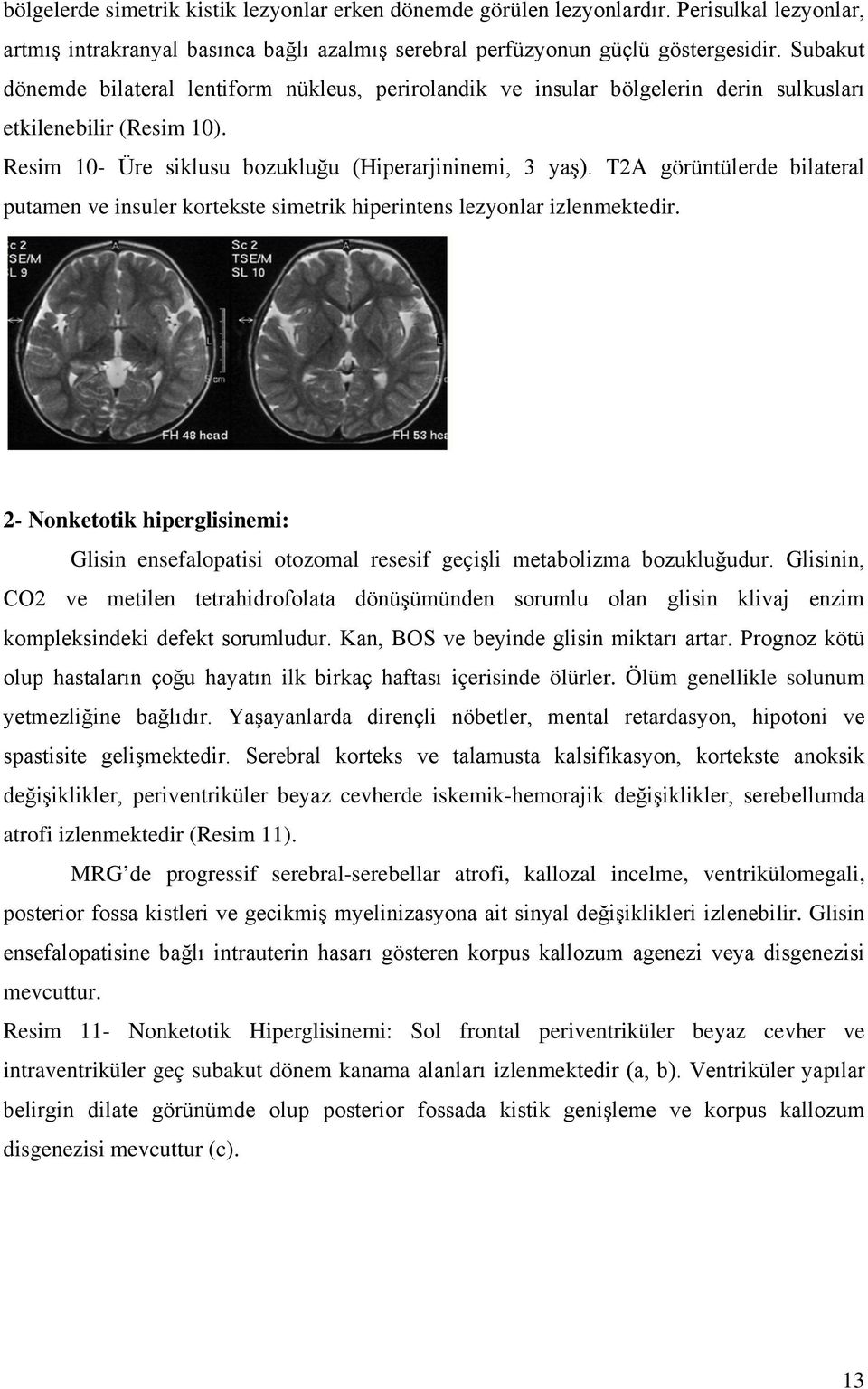 T2A görüntülerde bilateral putamen ve insuler kortekste simetrik hiperintens lezyonlar izlenmektedir.