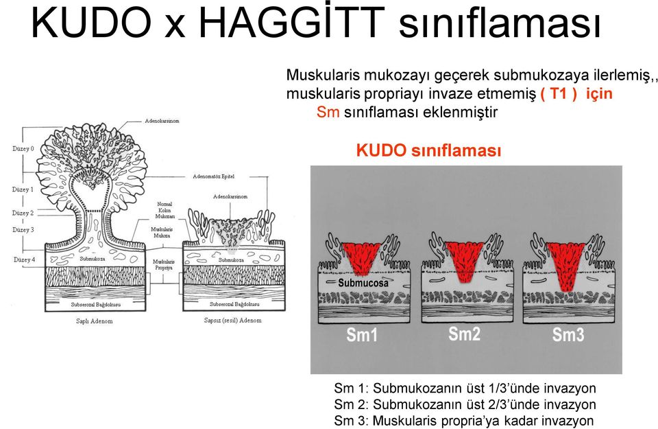 sınıflaması eklenmiştir KUDO sınıflaması Sm 1: Submukozanın üst 1/3 ünde