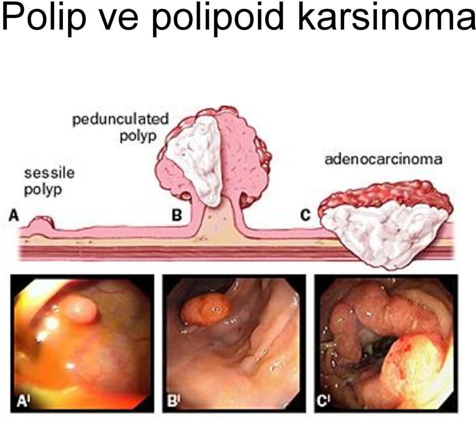 karsinoma