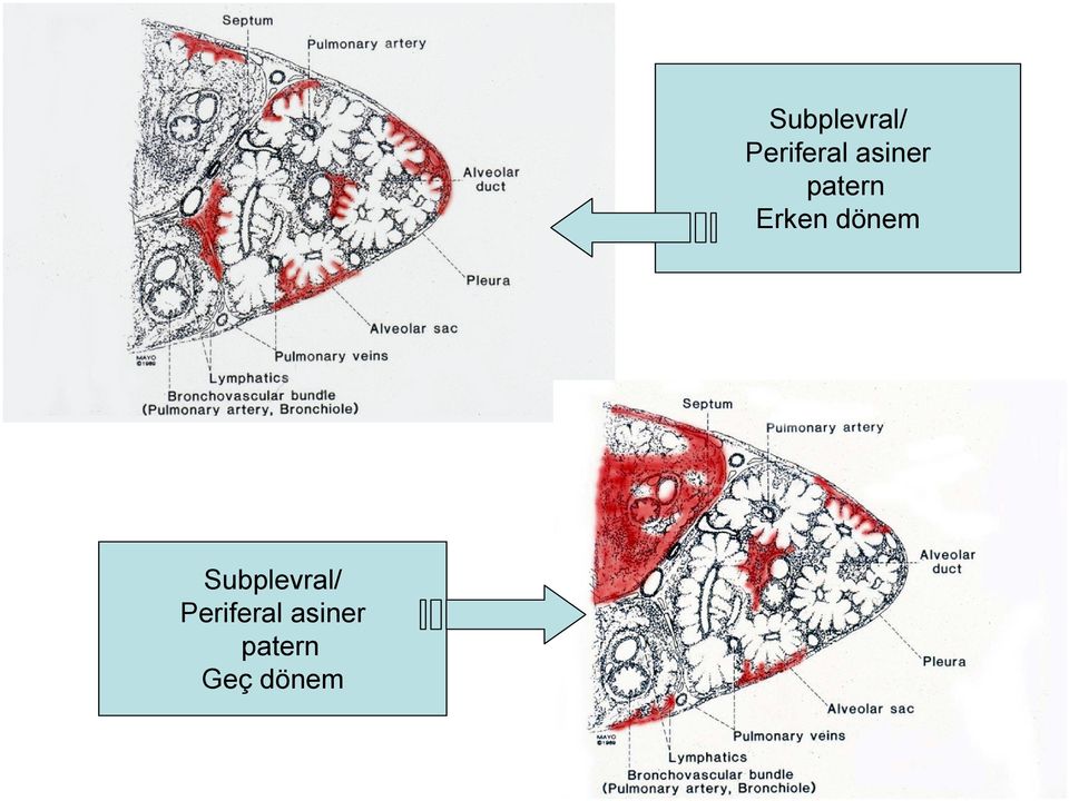 supplevral ve septal