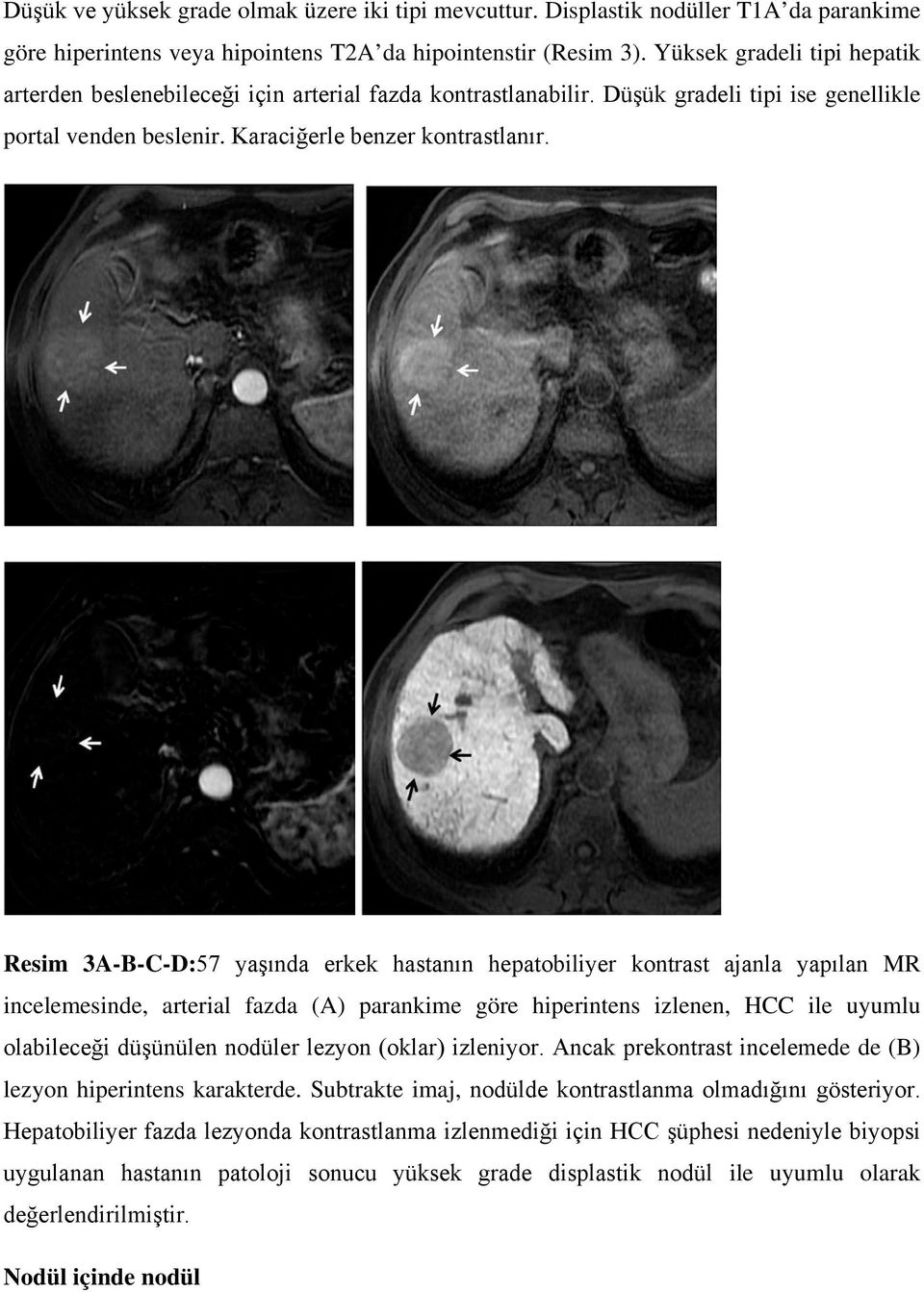 Resim 3A-B-C-D:57 yaşında erkek hastanın hepatobiliyer kontrast ajanla yapılan MR incelemesinde, arterial fazda (A) parankime göre hiperintens izlenen, HCC ile uyumlu olabileceği düşünülen nodüler