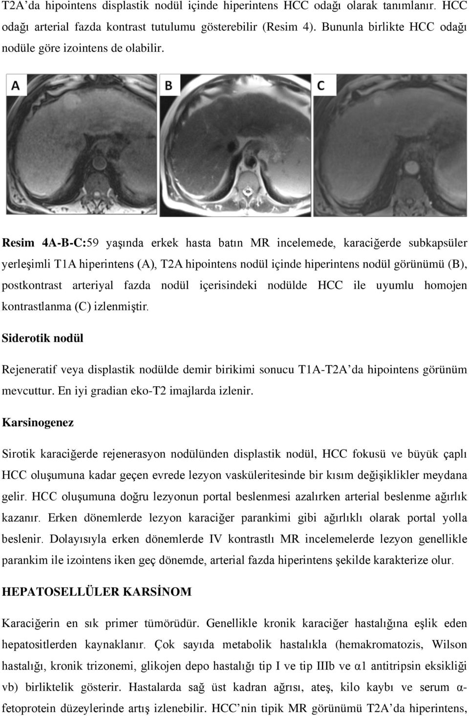 Resim 4A-B-C:59 yaşında erkek hasta batın MR incelemede, karaciğerde subkapsüler yerleşimli T1A hiperintens (A), T2A hipointens nodül içinde hiperintens nodül görünümü (B), postkontrast arteriyal