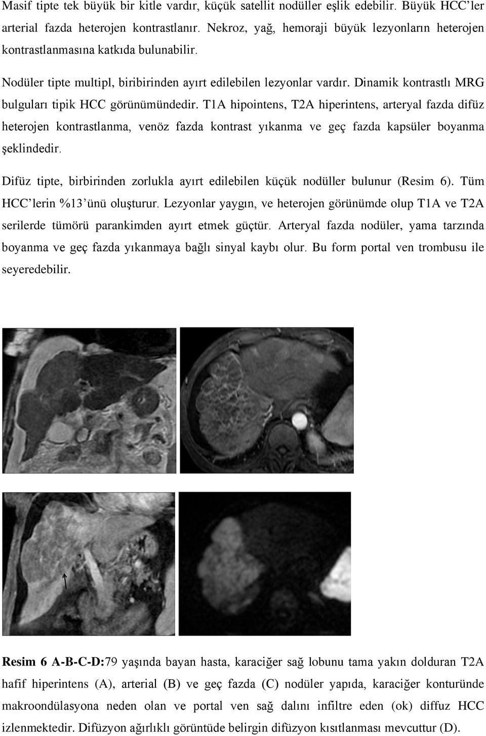 Dinamik kontrastlı MRG bulguları tipik HCC görünümündedir.