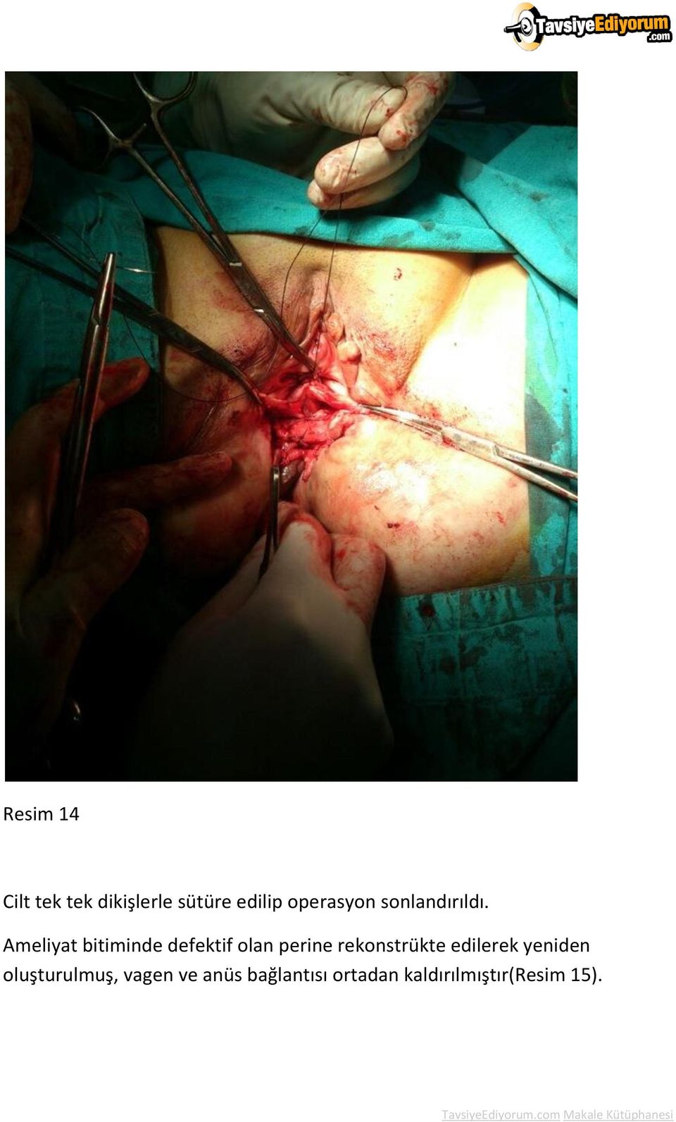 Ameliyat bitiminde defektif olan perine rekonstrükte