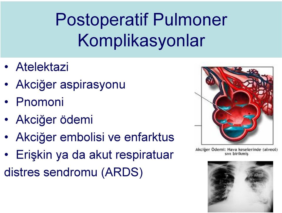Akciğer ödemi Akciğer embolisi ve enfarktus