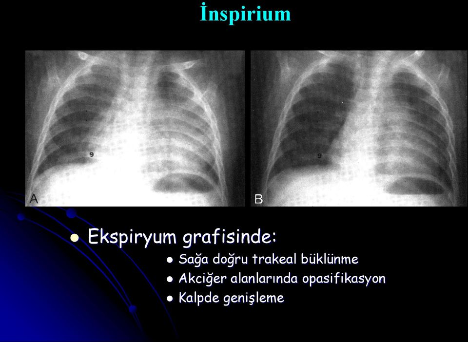 trakeal büklünme Akciğer